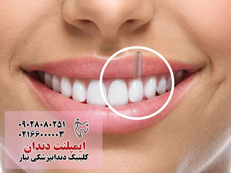 ایمپلنت دندان در تهران