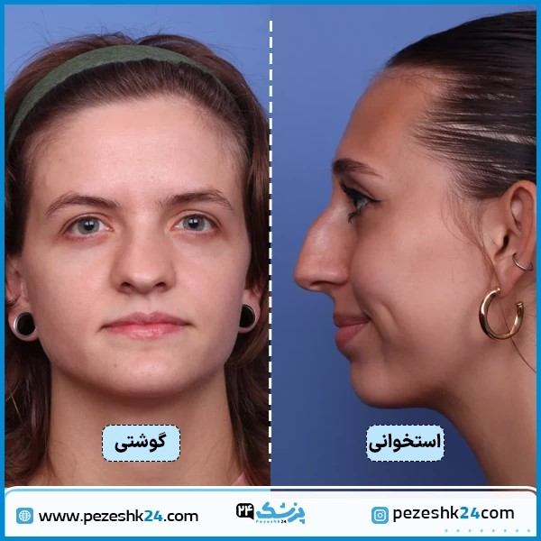 تفاوت بینی گوشتی و استخوانی پ