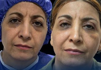 بلفاروپلاستی یا بوتاکس؟ کدام روش برای رفع افتادگی پلک بهتر است؟