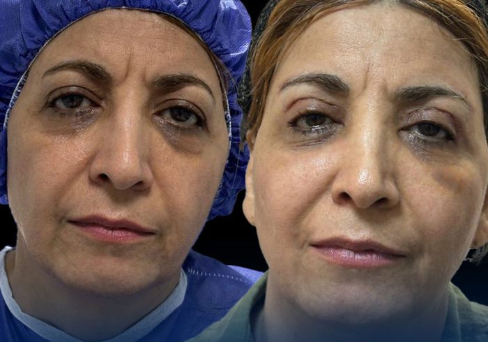 بلفاروپلاستی یا بوتاکس؟ کدام روش برای رفع افتادگی پلک بهتر است؟