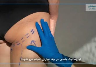 مدت زمان عمل لیپوماتیک باسن چقدر است و بازگشت به زندگی روزمره چقدر مدت زمان میبرد؟