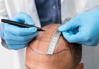 کاشت مو عروسکی چیست؟