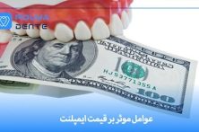 عوامل موثر بر قیمت ایمپلنت + چگونه خریدی به صرفه داشته باشیم؟