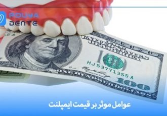 عوامل موثر بر قیمت ایمپلنت + چگونه خریدی به صرفه داشته باشیم؟