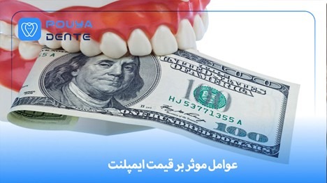 عوامل موثر بر قیمت ایمپلنت + چگونه خریدی به صرفه داشته باشیم؟