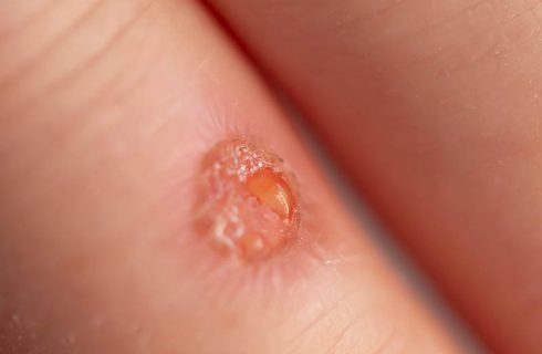 رنگ ترشحات زخم چه معنایی دارد و چه وقت باید پانسمان را عوض کرد؟