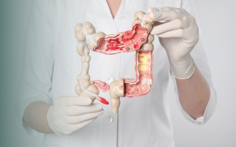 چرا نباید خونریزی مقعدی را نادیده گرفت؟ هشدار پزشکان درمان خونریزی مقعدی در هیوا لیزر