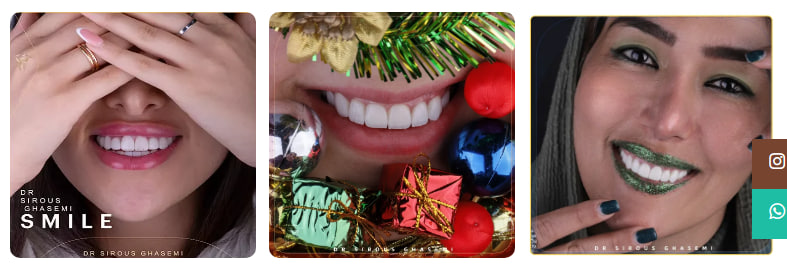 لمینت دندان در شیراز قاسمی