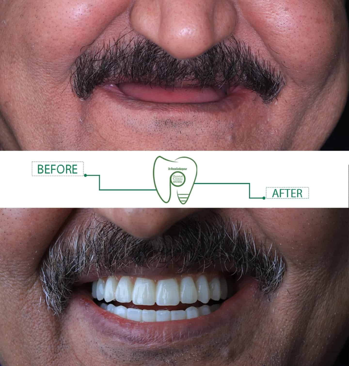 لبخند دوباره در کوتاهترین زمان | راهنمای تخصصی ایمپلنت دندان قیمت ایمپلنت دیجیتال شیراز