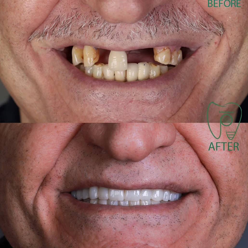 لبخند دوباره در کوتاهترین زمان | راهنمای تخصصی ایمپلنت دندان ایمپلنت فوری در شیراز