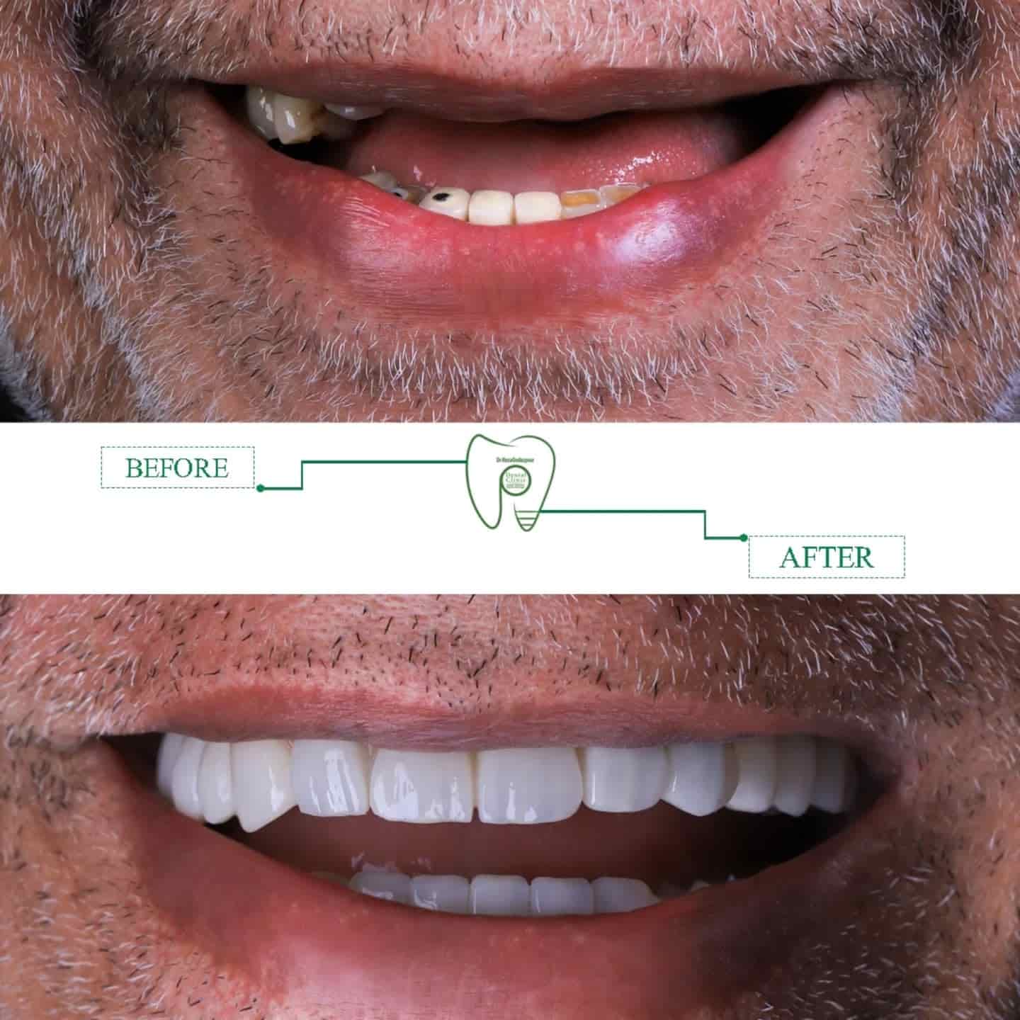 لبخند دوباره در کوتاهترین زمان | راهنمای تخصصی ایمپلنت دندان متخصص ایمپلنت در شیراز
