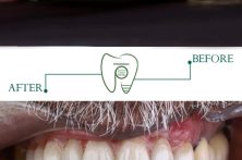 لبخند دوباره در کوتاه‌ترین زمان | راهنمای تخصصی ایمپلنت دندان