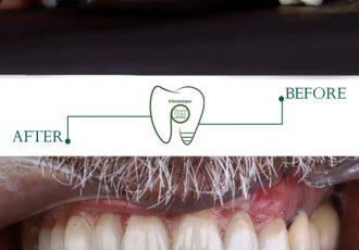 لبخند دوباره در کوتاه‌ترین زمان | راهنمای تخصصی ایمپلنت دندان