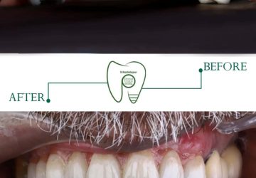 لبخند دوباره در کوتاه‌ترین زمان | راهنمای تخصصی ایمپلنت دندان