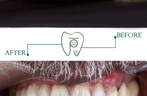 لبخند دوباره در کوتاه‌ترین زمان | راهنمای تخصصی ایمپلنت دندان