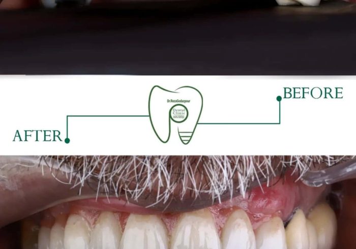 لبخند دوباره در کوتاه‌ترین زمان | راهنمای تخصصی ایمپلنت دندان