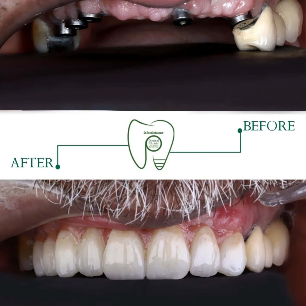 لبخند دوباره در کوتاه‌ترین زمان | راهنمای تخصصی ایمپلنت دندان