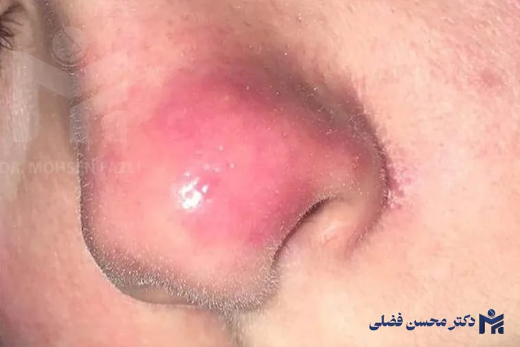 تکنیک طلایی بعد از جراحی بینی؛ ماساژی که چهره را متحول خواهد کرد