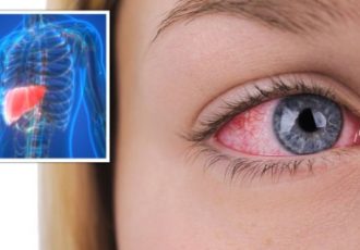 اگر چشمانتان این‌گونه به نظر برسد، کبدتان در خطر است