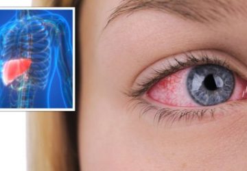 اگر چشمانتان این‌گونه به نظر برسد، کبدتان در خطر است