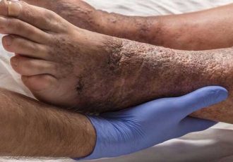 بی‌دردی زخم در افراد دیابتی نشانه پیشرفت آسیب عصبی است