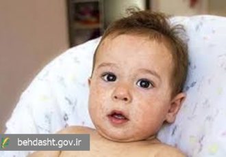 تب همراه با پتشی؛ نشانه‌ای هشداردهنده در کودکان