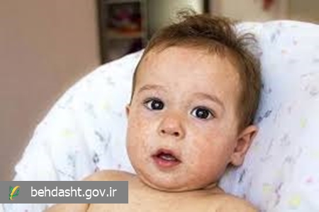 تب همراه با پتشی؛ نشانه‌ای هشداردهنده در کودکان