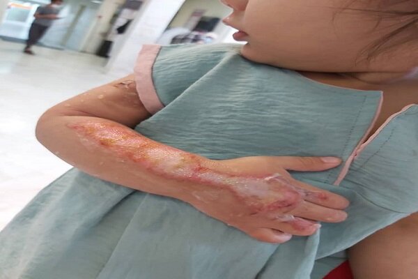 توصیه‌هایی برای پیشگیری از سوختگی