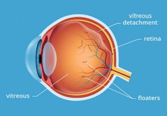 جداشدگی زجاجیه خلفی چیست و چرا ناگهان مگسپران میبینید؟ جداشدگی زجاجیه خلفی چیست و چرا ناگهان مگسپران میبینید؟