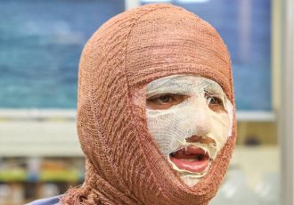 جلالی: سالانه حدود ۳۰۰ هزار نفر به مراکز سوختگی کشور مراجعه می‌کنند