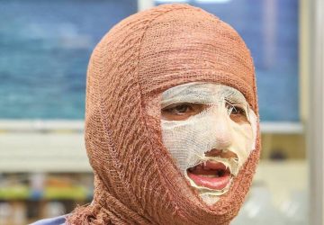 جلالی: سالانه حدود ۳۰۰ هزار نفر به مراکز سوختگی کشور مراجعه می‌کنند