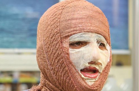 جلالی: سالانه حدود ۳۰۰ هزار نفر به مراکز سوختگی کشور مراجعه می‌کنند