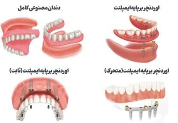 خداحافظی با لقی دندان مصنوعی؛ راهنمای جامع اوردنچر با ایمپلنت برای سالمندان