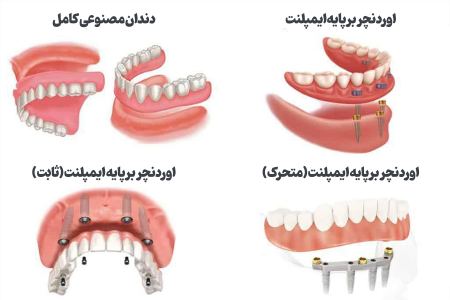 خداحافظی با لقی دندان مصنوعی؛ راهنمای جامع اوردنچر با ایمپلنت برای سالمندان خداحافظی با لقی دندان مصنوعی؛ راهنمای جامع اوردنچر با ایمپلنت برای سالمندان