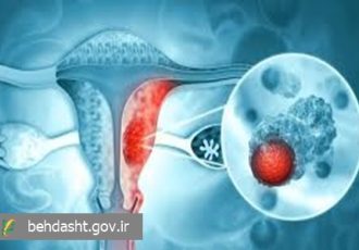 درمان بیش از ۲۰۰ بیمار مبتلا به تومورهای رحم، دهانه رحم و ضایعات پوستی طی یک سال اخیر