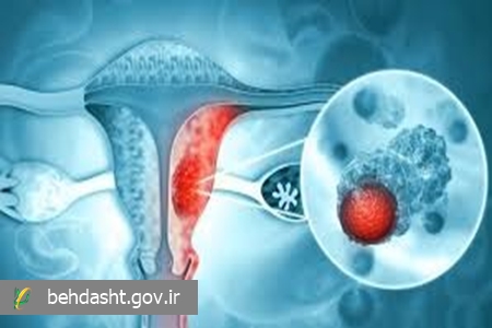 درمان بیش از ۲۰۰ بیمار مبتلا به تومورهای رحم، دهانه رحم و ضایعات پوستی طی یک سال اخیر