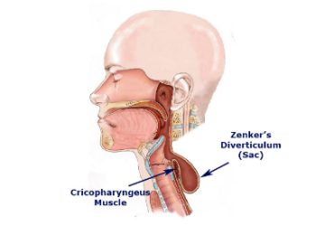 دیورتیکولوم زنکر؛ علت، علائم و درمان مدرن بدون جراحی باز