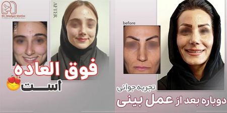 بررسی نمونه کارهای عمل بینی پزشک