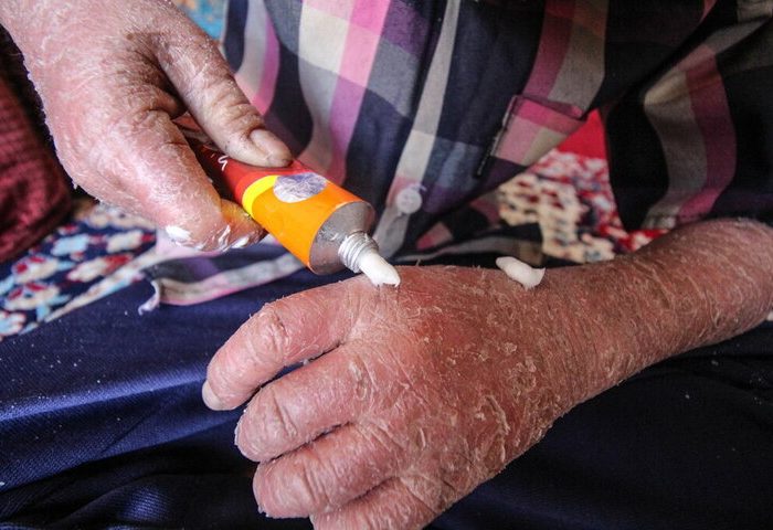 لزوم شفافیت بودجه‌ای انجمن‌های حمایت از بیماران