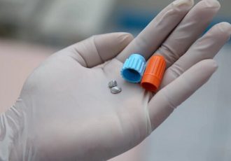 پرکردن دندان با آمالگام؛ از مزایا تا معایب آن پرکردن دندان با آمالگام؛ از مزایا تا معایب آن