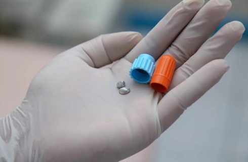 پرکردن دندان با آمالگام؛ از مزایا تا معایب آن پرکردن دندان با آمالگام؛ از مزایا تا معایب آن