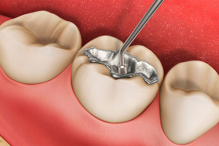 پرکردن دندان با آمالگام؛ از مزایا تا معایب آن پرکردن دندان با آمالگام؛ از مزایا تا معایب آن