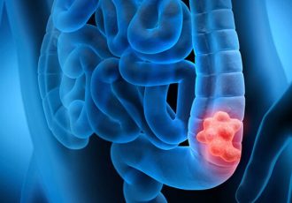 چطور جلوی سرطان روده را بگیریم؟ چطور جلوی سرطان روده را بگیریم؟