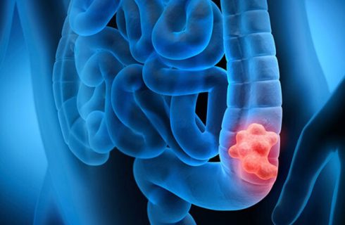 چطور جلوی سرطان روده را بگیریم؟ چطور جلوی سرطان روده را بگیریم؟