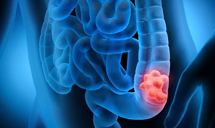 چطور جلوی سرطان روده را بگیریم؟