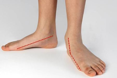 علائم هشداردهنده انحراف زانو ناشی از کف پای صاف علائم هشداردهنده انحراف زانو ناشی از کف پای صاف