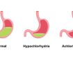 کمبود اسید معده یا هیپوکلریدریا؛ اختلالی خاموش در پشت بسیاری از مشکلات گوارشی مزمن