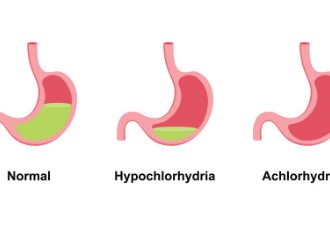 کمبود اسید معده یا هیپوکلریدریا؛ اختلالی خاموش در پشت بسیاری از مشکلات گوارشی مزمن