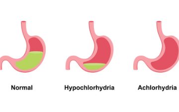 کمبود اسید معده یا هیپوکلریدریا؛ اختلالی خاموش در پشت بسیاری از مشکلات گوارشی مزمن