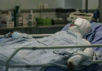 ۸۵ درصد سوختگی‌ها با روش‌های ساده قابل پیشگیری است